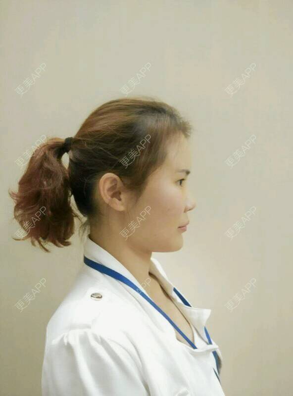 更美 - 黄丽华 医生的自体脂肪全面部填充经验 | 自体脂肪全面部填充 | 深圳