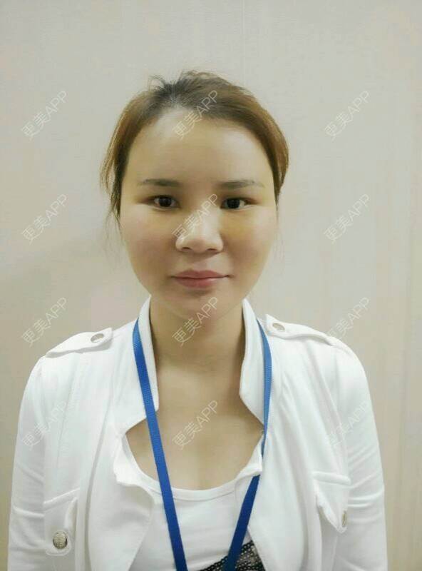 更美 - 黄丽华 医生的自体脂肪全面部填充经验 | 自体脂肪全面部填充 | 深圳