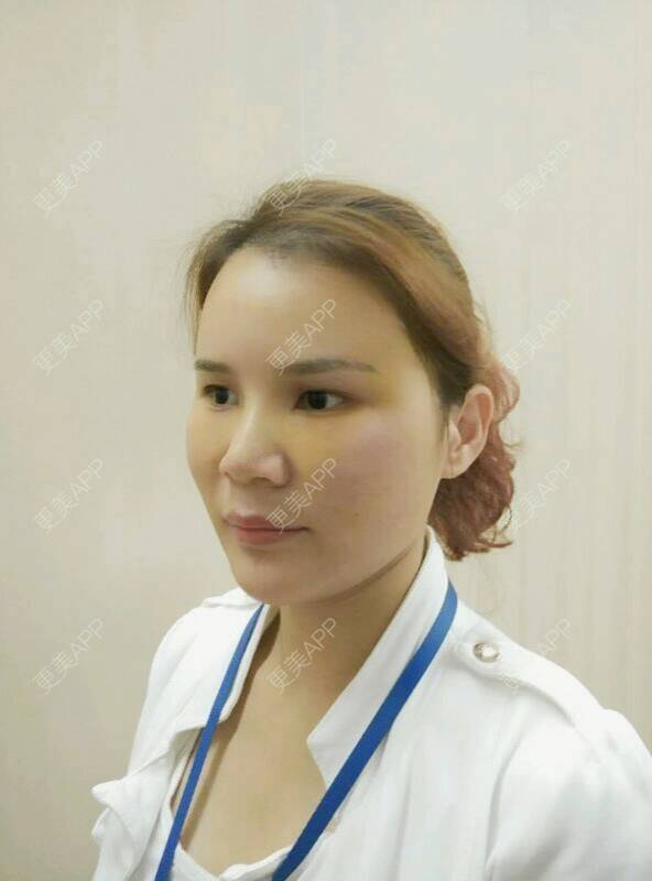 更美 - 黄丽华 医生的自体脂肪全面部填充经验 | 自体脂肪全面部填充 | 深圳