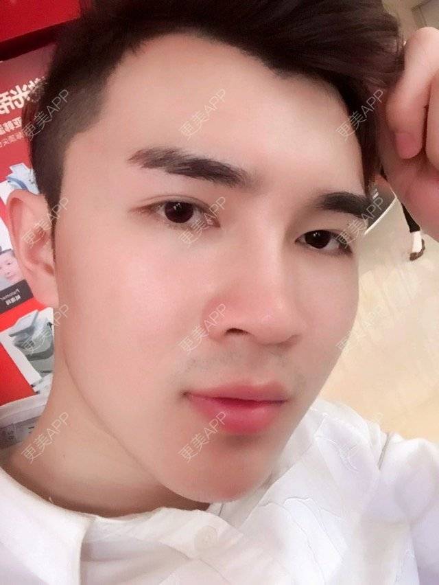 更美 - 笑笑笑水阁的玻尿酸额头经验 | 玻尿酸额头 | 长沙