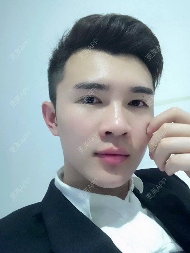 更美 - 笑笑笑水阁的玻尿酸额头经验 | 玻尿酸额头 | 长沙