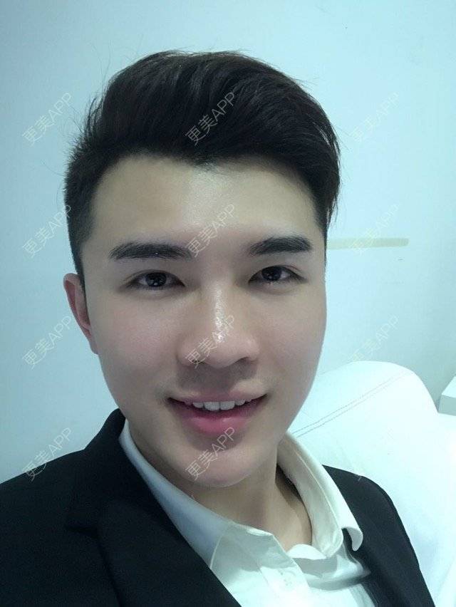 更美 - 笑笑笑水阁的玻尿酸额头经验 | 玻尿酸额头 | 长沙