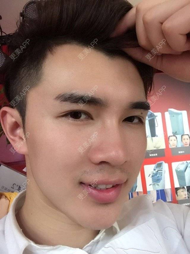 更美 - 笑笑笑水阁的玻尿酸额头经验 | 玻尿酸额头 | 长沙