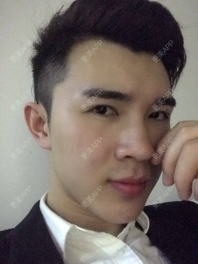 更美 - 笑笑笑水阁的玻尿酸额头经验 | 玻尿酸额头 | 长沙