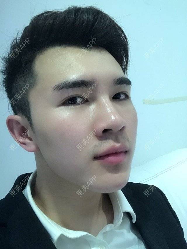 更美 - 笑笑笑水阁的玻尿酸额头经验 | 玻尿酸额头 | 长沙