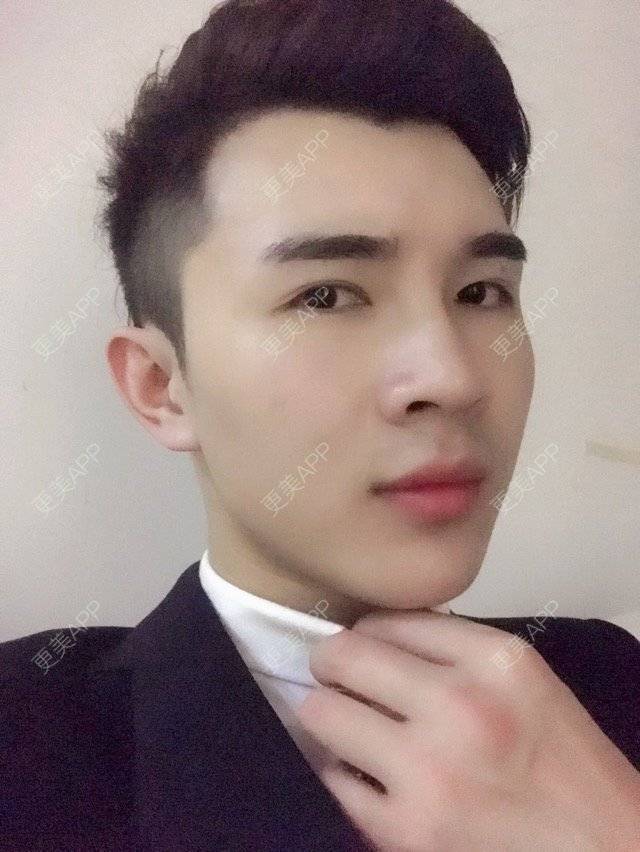 更美 - 笑笑笑水阁的玻尿酸额头经验 | 玻尿酸额头 | 长沙