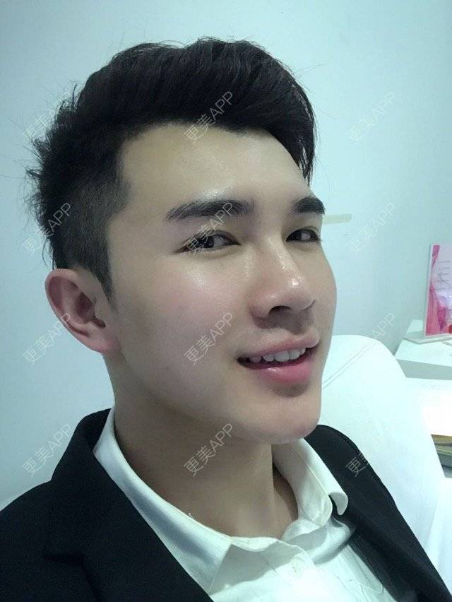 更美 - 笑笑笑水阁的玻尿酸额头经验 | 玻尿酸额头 | 长沙