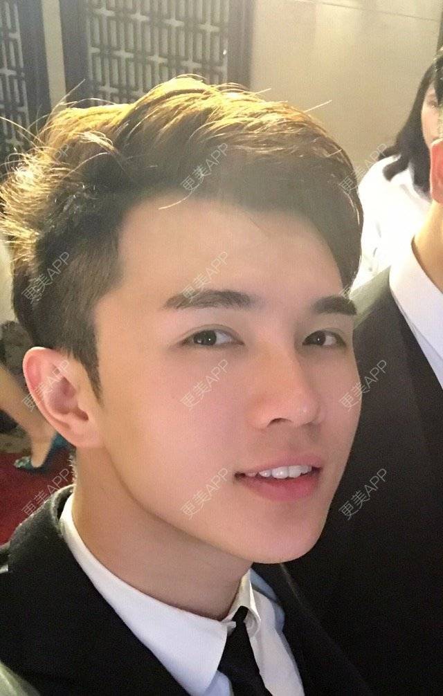 更美 - 笑笑笑水阁的玻尿酸额头经验 | 玻尿酸额头 | 长沙