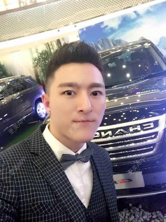 更美 - 柳安花明又一村的玻尿酸额头经验 | 长沙 | 玻尿酸额头