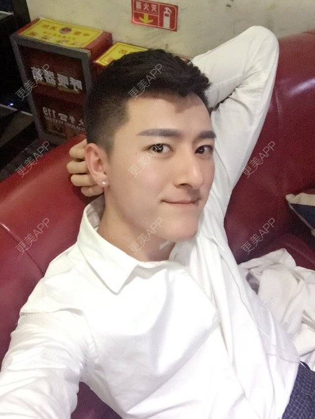 更美 - 柳安花明又一村的玻尿酸额头经验 | 长沙 | 玻尿酸额头