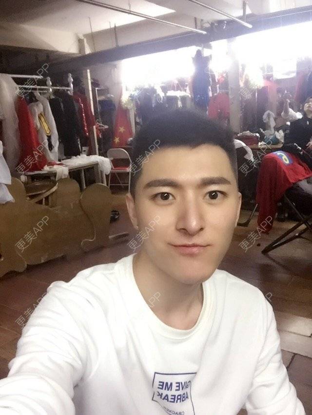 更美 - 柳安花明又一村的玻尿酸额头经验 | 长沙 | 玻尿酸额头