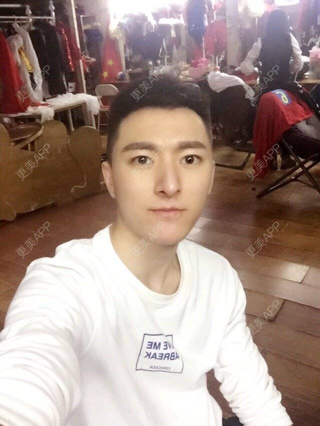 更美 - 柳安花明又一村的玻尿酸额头经验 | 长沙 | 玻尿酸额头