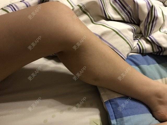 更美 - 怕疼的丢丢的经验 | 注射塑形腿部 | 南京