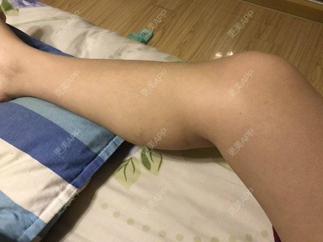 更美 - 怕疼的丢丢的经验 | 注射塑形腿部 | 南京