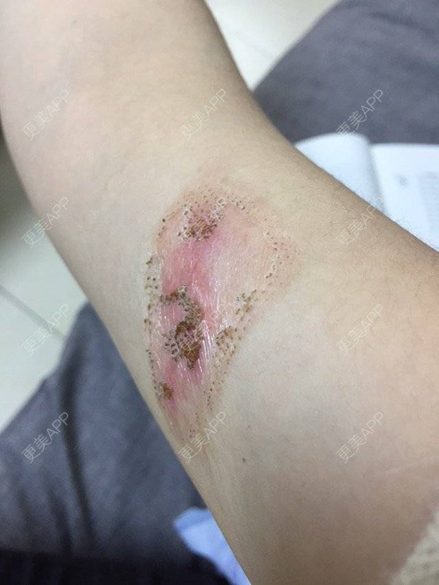 向阳葵21的激光淡疤日记