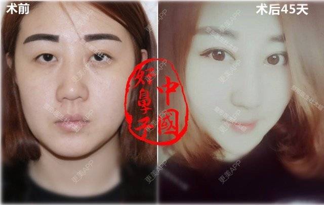 更美 - 杜太超 医生的经验 | 眼部多项 | 隆鼻 | 鼻部多项 | 北京