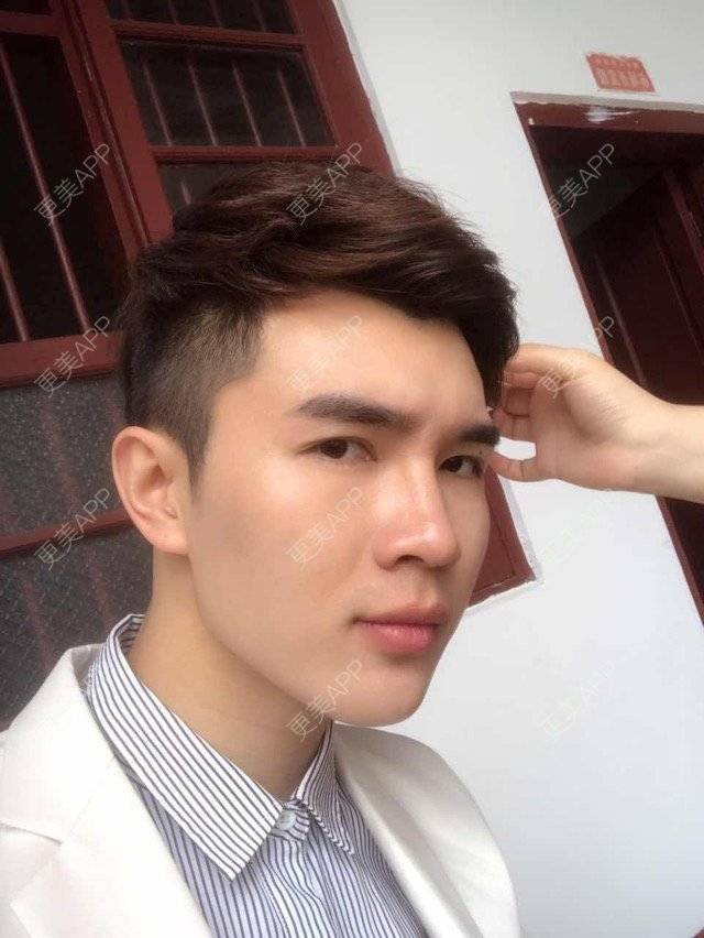 更美 - 笑笑笑水阁的玻尿酸额头经验 | 玻尿酸额头 | 长沙