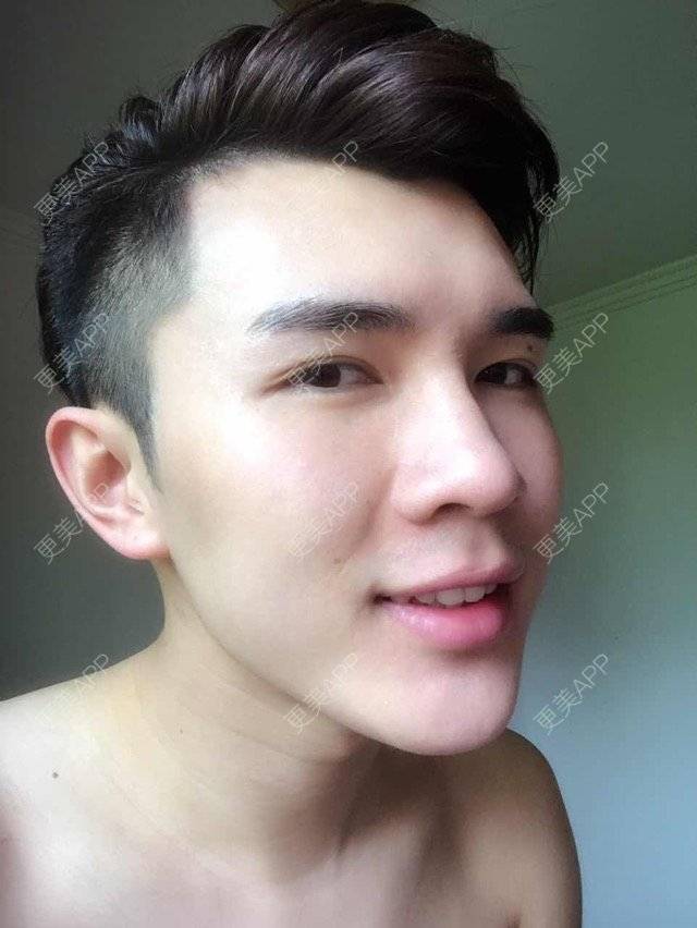 更美 - 笑笑笑水阁的玻尿酸额头经验 | 玻尿酸额头 | 长沙