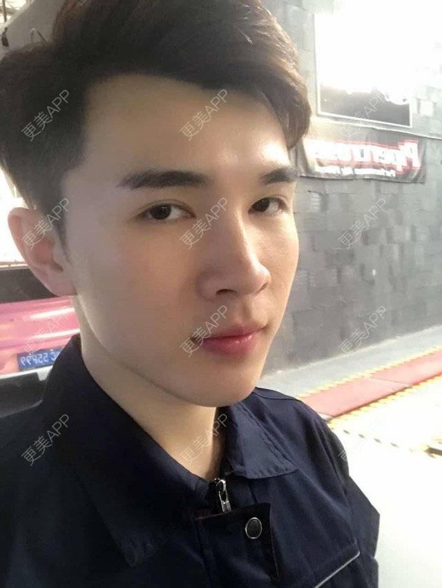 更美 - 笑笑笑水阁的玻尿酸额头经验 | 玻尿酸额头 | 长沙