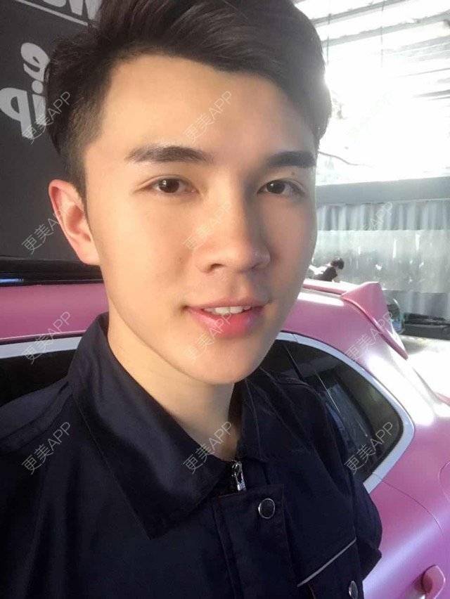 更美 - 笑笑笑水阁的玻尿酸额头经验 | 玻尿酸额头 | 长沙