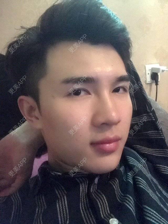 更美 - 笑笑笑水阁的玻尿酸额头经验 | 玻尿酸额头 | 长沙