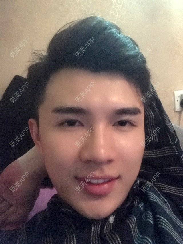 更美 - 笑笑笑水阁的玻尿酸额头经验 | 玻尿酸额头 | 长沙