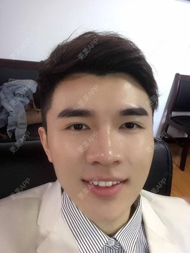 更美 - 笑笑笑水阁的玻尿酸额头经验 | 玻尿酸额头 | 长沙