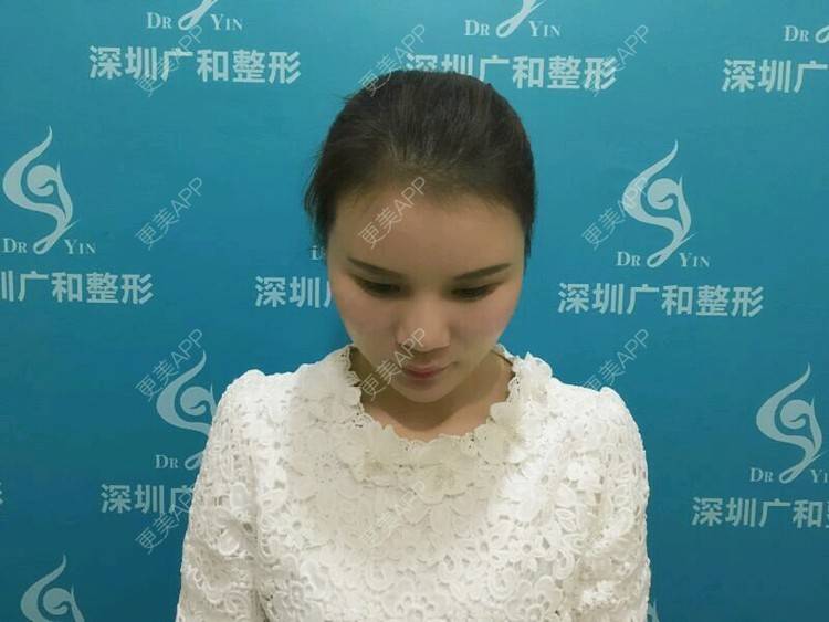 更美 - 黄丽华 医生的自体脂肪全面部填充经验 | 自体脂肪全面部填充 | 深圳