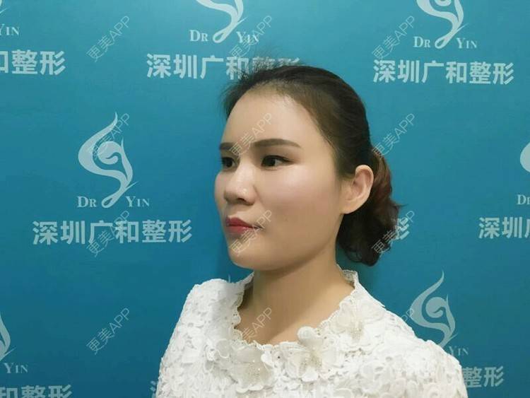 更美 - 黄丽华 医生的自体脂肪全面部填充经验 | 自体脂肪全面部填充 | 深圳