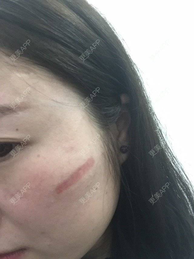 更美 - 小幸运小幸运小幸运的经验 | 去除疤痕 | 荆州