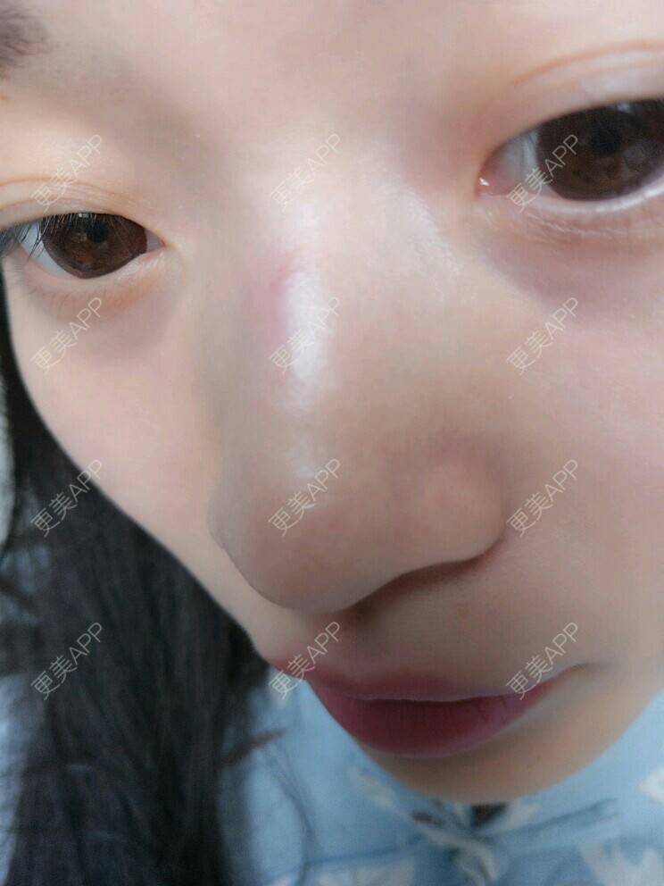 更美 - zzzzzz-的经验 | 鼻部整形 | 玻尿酸鼻部 | 玻尿酸下巴鼻山根 | 北京