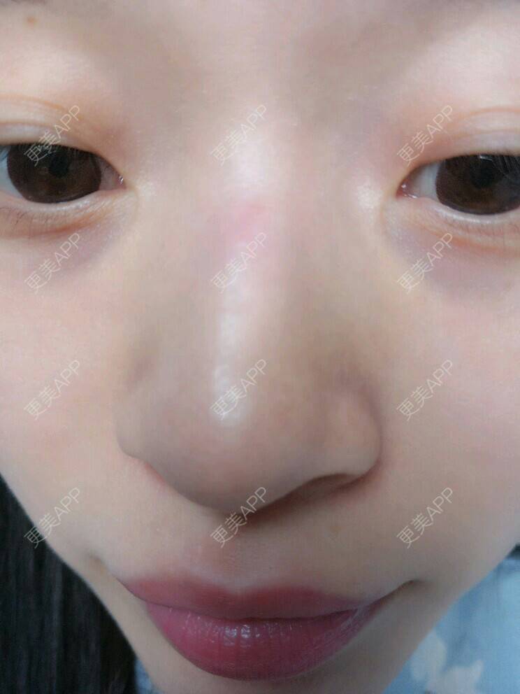 更美 - zzzzzz-的经验 | 鼻部整形 | 玻尿酸鼻部 | 玻尿酸下巴鼻山根 | 北京