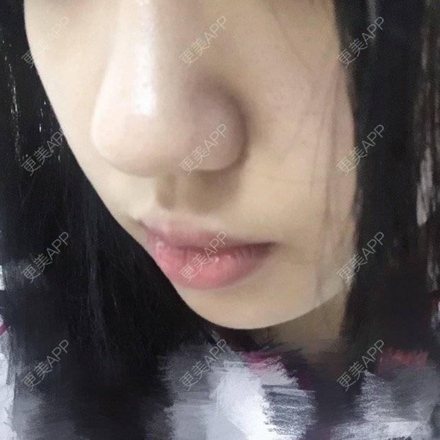 更美 - i3xx🖤的经验 | 鼻翼缩小 | 广州