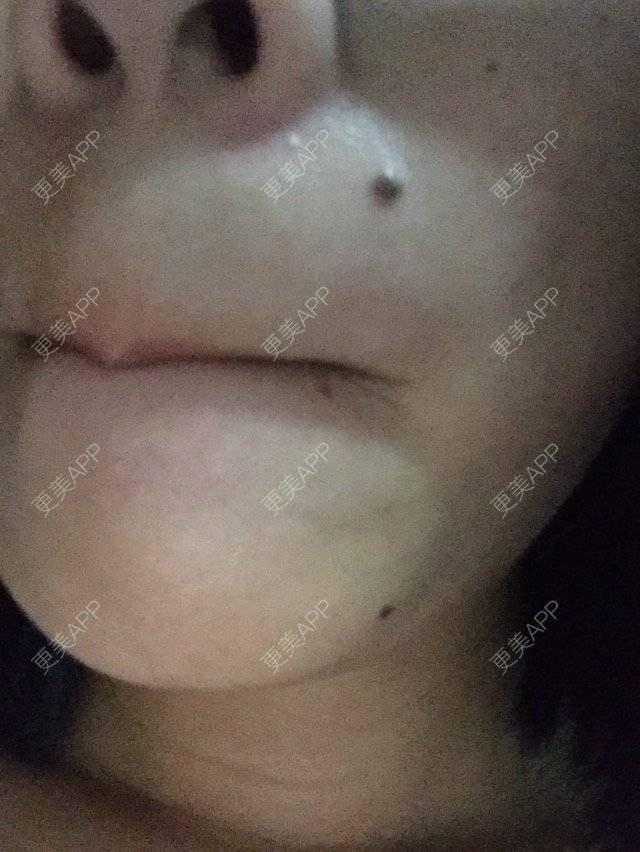 更美 - ∑＇αγαπώ 華的经验 | 去痣 | 黔南