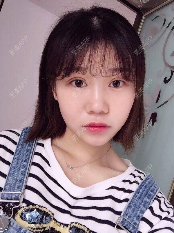 更美 - 章小玲玲的全切双眼皮日记 | 南昌 | 全切双眼皮