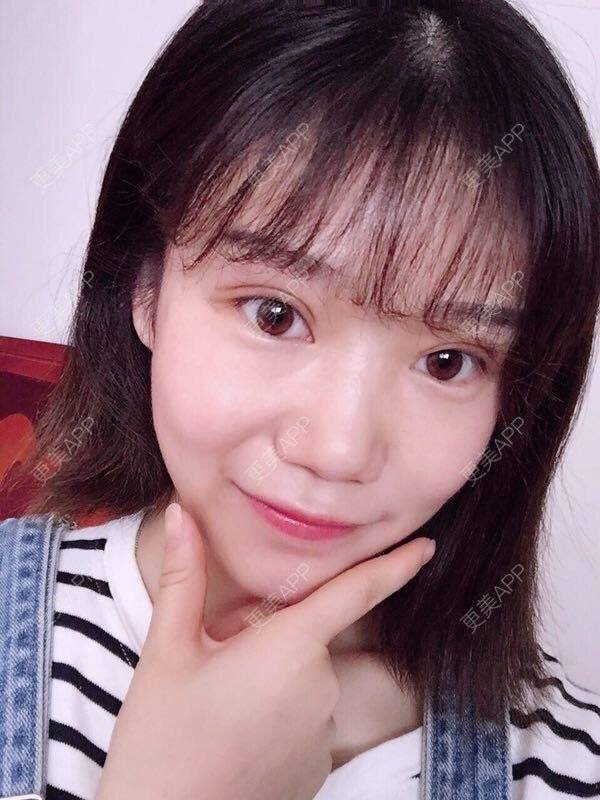 更美 - 章小玲玲的全切双眼皮日记 | 南昌 | 全切双眼皮