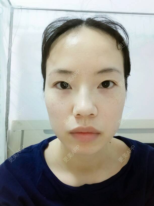 更美 - 更美用户JPLSyVzoIU的经验 | 眼部整形 | 面部轮廓 | 近视矫正 | 桂林