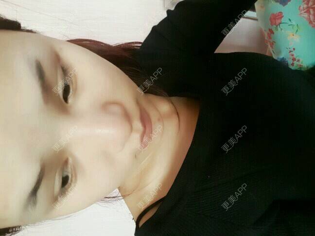 更美 - 好大一个桃子的经验 | 眼部整形 | 眼部多项 | 眼睑下至 | 岳阳