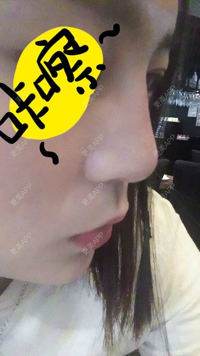 更美 - Liu脸脸爱喝Niu奶🍼的经验 | 玻尿酸鼻部 | 徐州