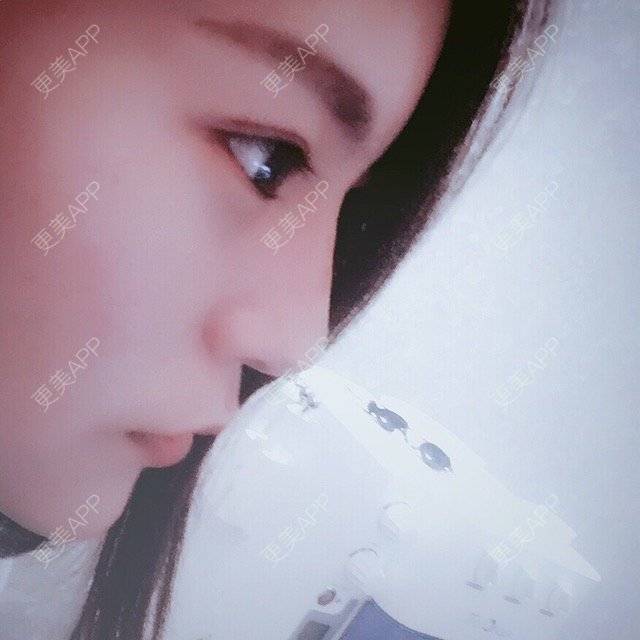 更美 - Liu脸脸爱喝Niu奶🍼的经验 | 玻尿酸鼻部 | 徐州
