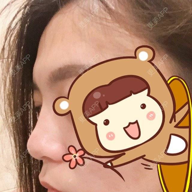 更美 - Liu脸脸爱喝Niu奶🍼的经验 | 玻尿酸鼻部 | 徐州