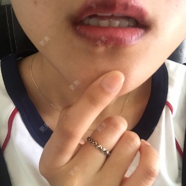 为什么漂唇掉完结痂一周后唇部发紫发黑呢