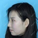 更美 - 李家彪 医生的全切双眼皮经验 | 全切双眼皮 | 郑州