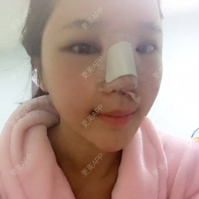 更美 - 梁小柱有大大的梦想的隆鼻经验 | 膨体隆鼻 | 南宁 | 鼻头整形 | 隆鼻