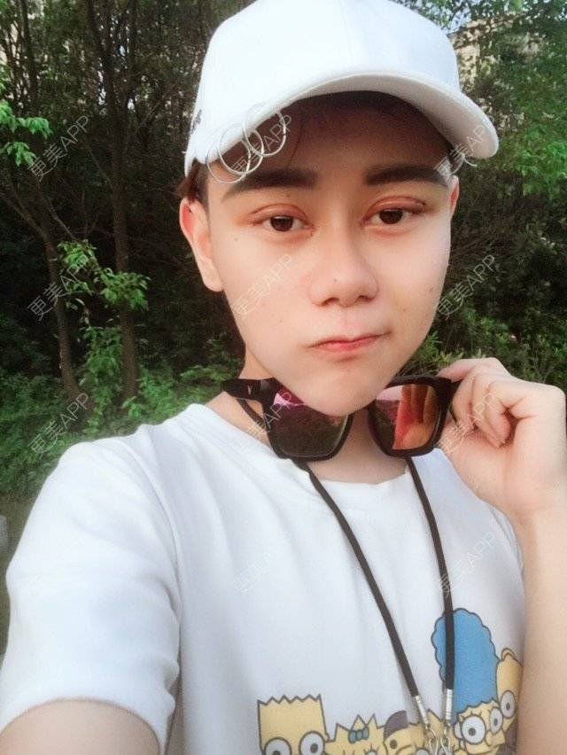 更美 - 晓羽呀的鼻部多项经验 | 鼻部修复 | 长沙 | 缩小鼻翼 | 鼻部多项