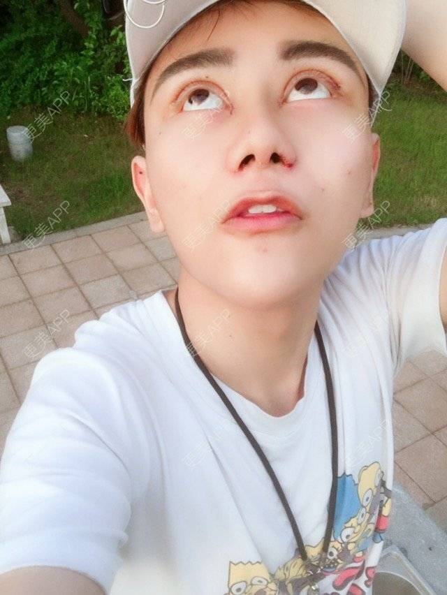 更美 - 晓羽呀的鼻部多项经验 | 鼻部修复 | 长沙 | 缩小鼻翼 | 鼻部多项