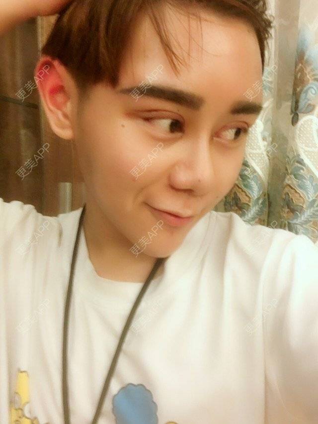 更美 - 晓羽呀的鼻部多项经验 | 鼻部修复 | 长沙 | 缩小鼻翼 | 鼻部多项