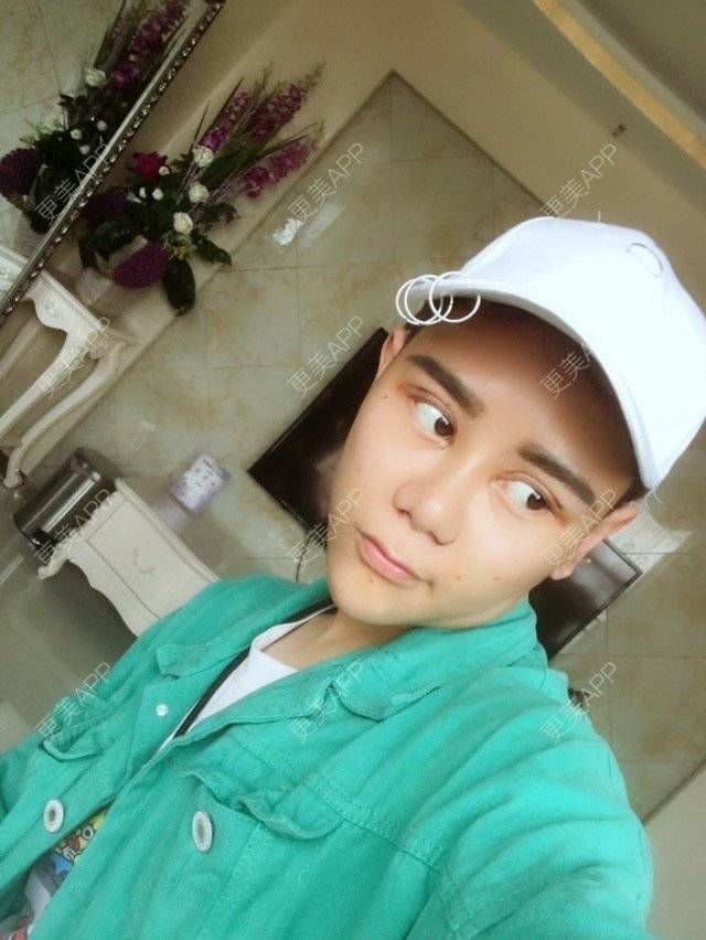 更美 - 晓羽呀的鼻部多项经验 | 鼻部修复 | 长沙 | 缩小鼻翼 | 鼻部多项