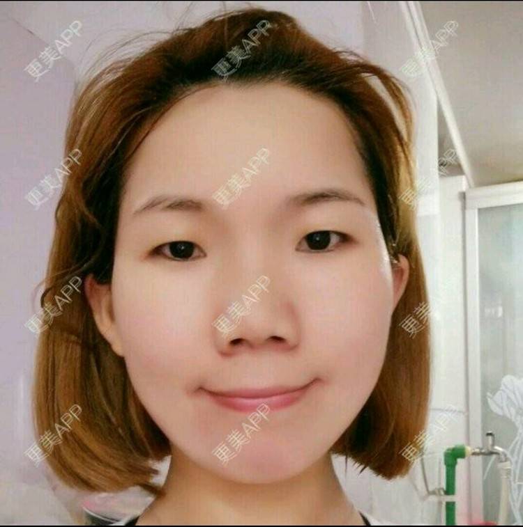 更美 - A· 美美哒的经验 | 眼部整形 | 上海