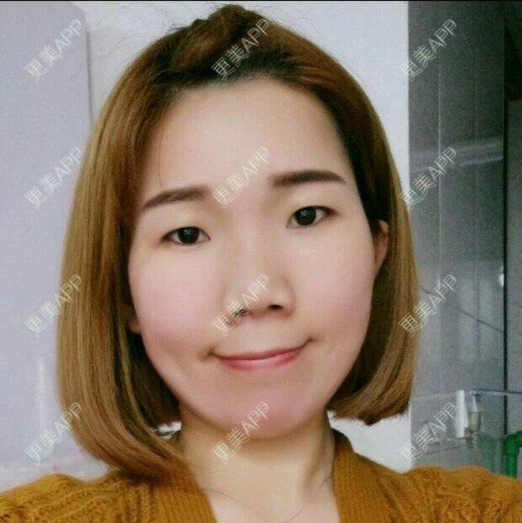 更美 - A· 美美哒的经验 | 眼部整形 | 上海